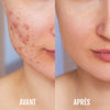 DermaClear - Luminothérapie Anti-Acné