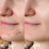 DermaClear - Luminothérapie Anti-Acné