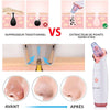 SkinClear 3 - Aspirateur à Points Noirs Professionnel