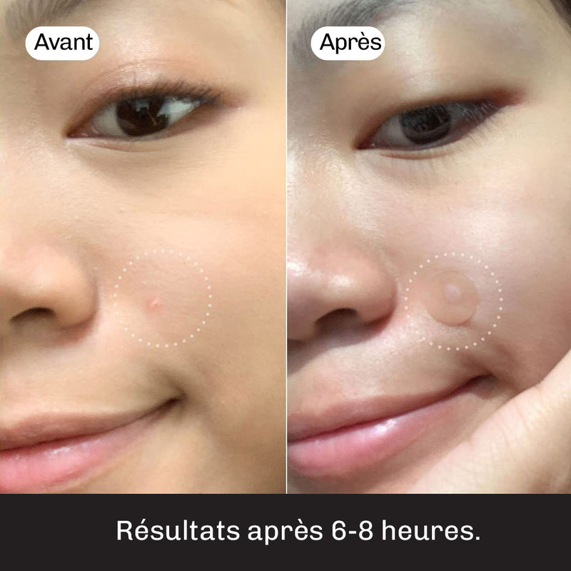 Patchs anti-boutons invisibles