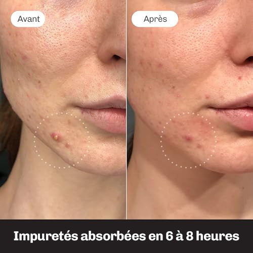 Patchs anti-boutons invisibles