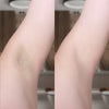 Epilateur Laser Permanent