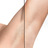 Epilateur Laser Permanent